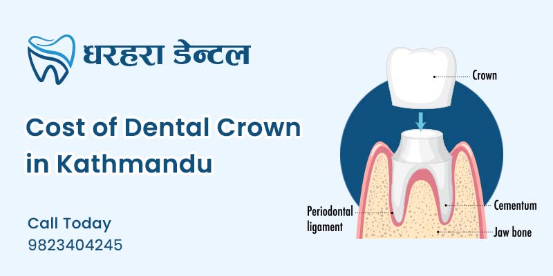 Cost of Dental Crown in Kathmandu