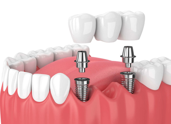Post-Implant Care: After Dental Implant Surgery | Dharahra Dental