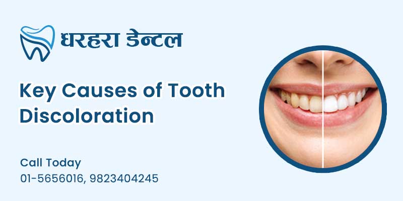 Causes of Tooth Discoloration