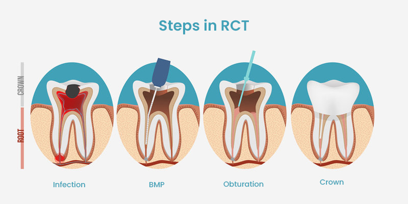 All About Root Canal Treatments (RCTs): A Comprehensive Guide