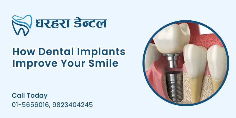 Dental Implants in Kathmandu