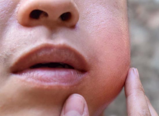 Tooth Pain and Swelling