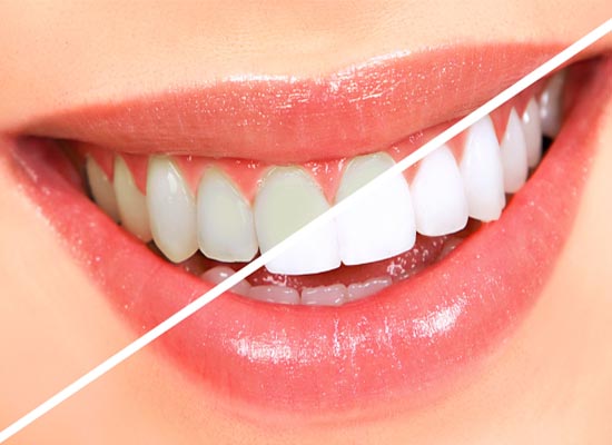 Post-Treatment Care: After Teeth Bleaching | Dharahra Dental