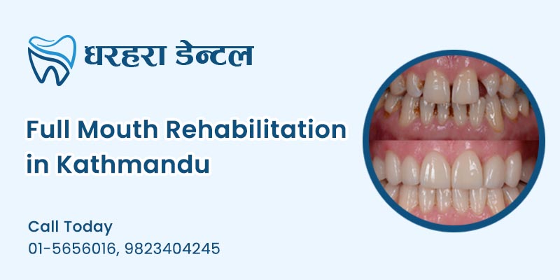Full Mouth Rehabilitation in Kathmandu