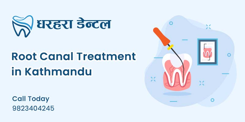 Root Canal Treatment in Kathmandu