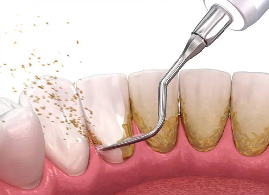 Post-Filling Care: After Dental Filling | Dharahra Dental