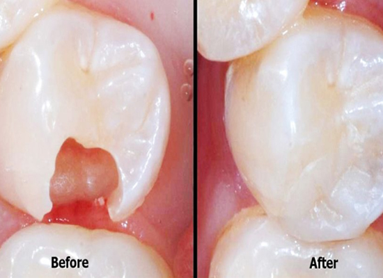 Post-Filling Care: After Dental Filling | Dharahra Dental