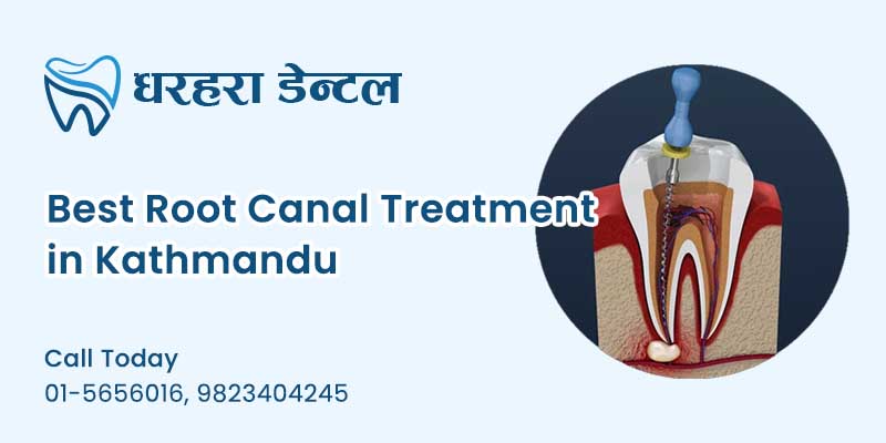 Single Visit Root Canal