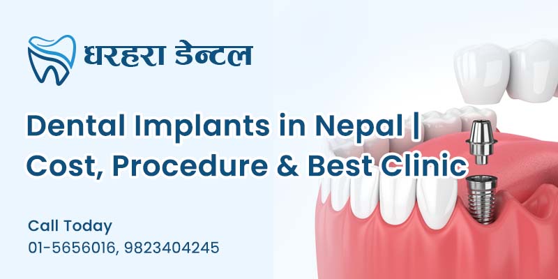 Dental Implants in Nepal