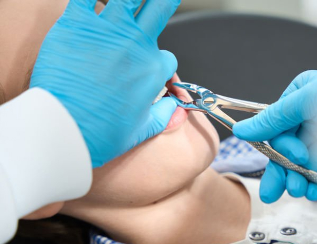 Post-Extraction Care: After Dental Extraction | Dharahra Dental