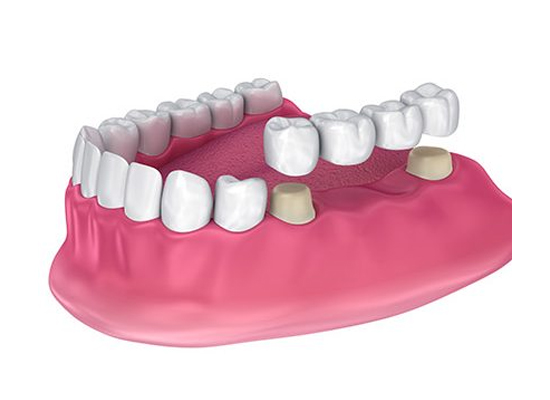 Post-Treatment Care: After Crown, Bridge & Dentures | Dharahra Dental